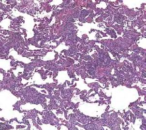 malignant neoplasms, sarcoidosis, Langerhans cell histiocytosis, and various bronchiolocentric diseases.