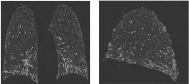 The various patterns of diffuse lung disease seen at high- resolution CT have all been described. This information is now being used for volumetric multi detector row CT.