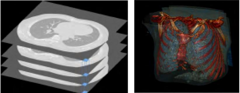 Figure 2.7: Volume rendering reconstruction of the same case (Fig. 2.6) that allows imaging of the thoracic cage bone algorithm. 2.5 PATTERN RECOGNITION ON HRCT Radiological findings on HRCT may be categorized to groups according to the impact on lung attenuation.