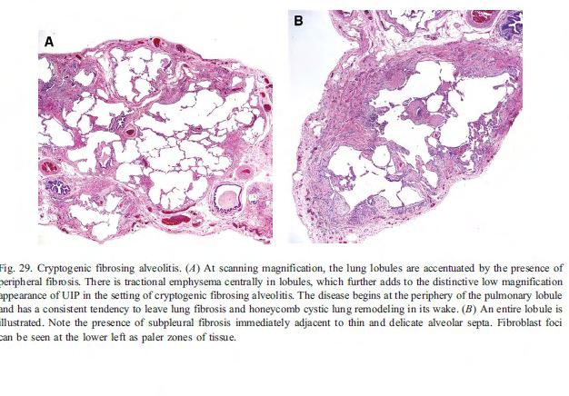 Interstitial inflammation and honeycombing alternate with normal lung (Figure 2.14). Multiple biopsy specimens need to be evaluated due to the patchy involvement.