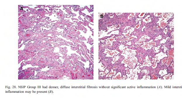 Ø Histologic Features: The histologic pattern of NSIP is characterized by temporally and spatially homogeneous lung involvement.