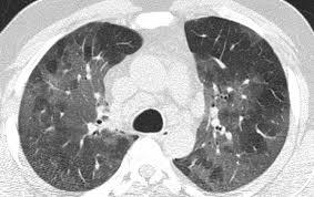 decades of life and is more common in men. Insidious onset of dyspnea and dry cough over weeks or months is usual and patients may progress to respiratory failure.
