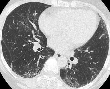COP may be associated with scleroderma. High- resolution CT frequently shows interstitial pneumonitis and fibrosis.