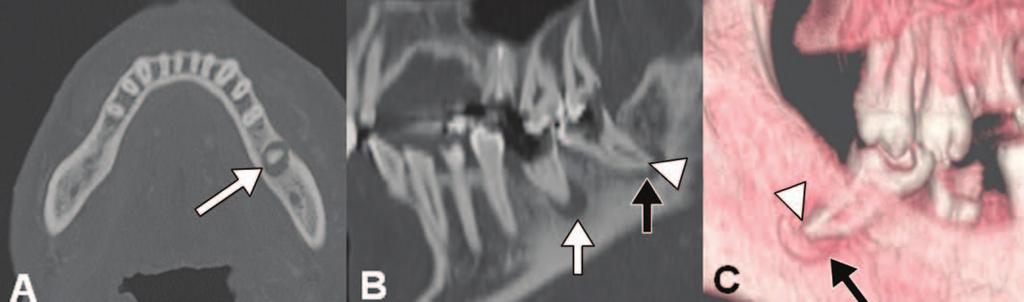 Dentigerous cysts can vary in size but have the potential to grow large enough to cause significant expansion of the jaw and displacement of adjacent teeth; however, resorption of the root apex is