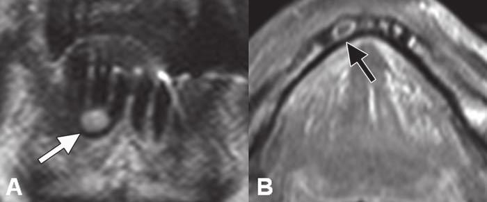 Lesions of the Mandible Fig. 3 62-year-old woman with periapical cyst. A, Coronal T2-weighted MR image shows high signal in anterior body of mandible (arrow).