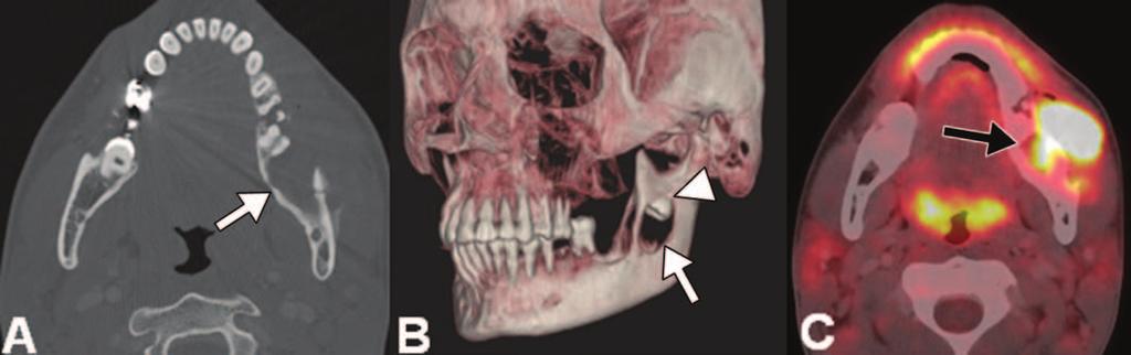 B, Axial contrast-enhanced CT image obtained using soft-tissue algorithm shows cystic lesion with mild peripheral enhancement (arrow) breaking through cortex and extending into left masseter muscle.