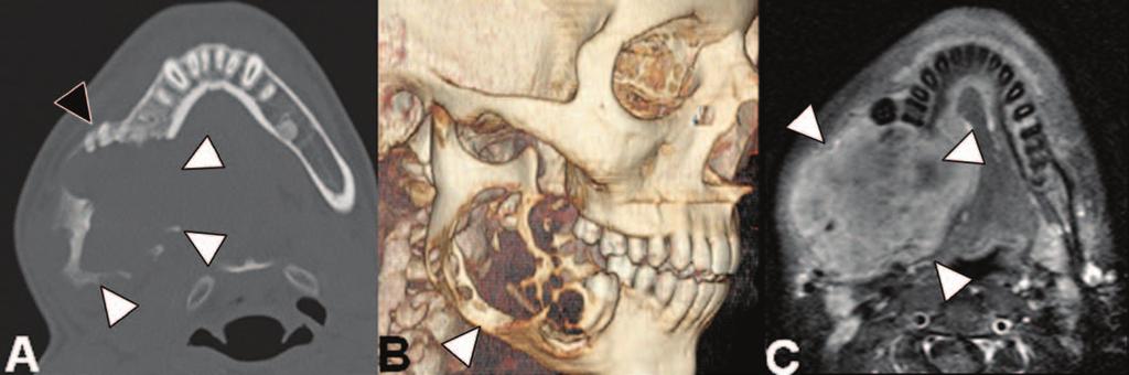 lesion (arrows, A and C) in posterior body of mandibular ramus. Significant cortical thinning and remodeling are seen particularly in lingual cortex.