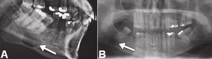Devenney-Cakir et al. contain multiloculations and bony septa, complete excision can be challenging.
