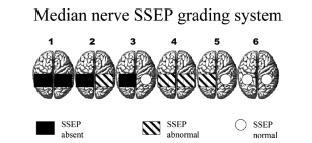 Single center prospective study (n=81) Median nerve SSEP