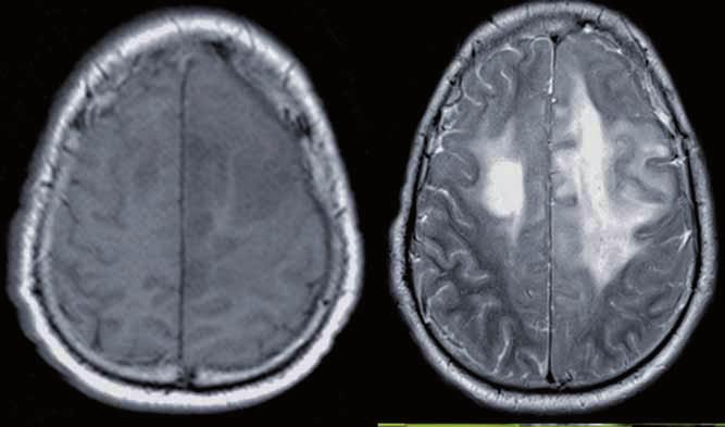 www.centauro.it The Neuroradiology Journal 27: 75-84, 2014 - doi: 10.