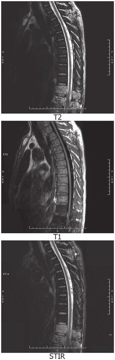 1072 Figure 4. The fibrous connective tissue and bone tissue of the second lumbar vertebrae and paravertebrae in the papillary mucinous epithelial cyst. Discussion Figure 3.