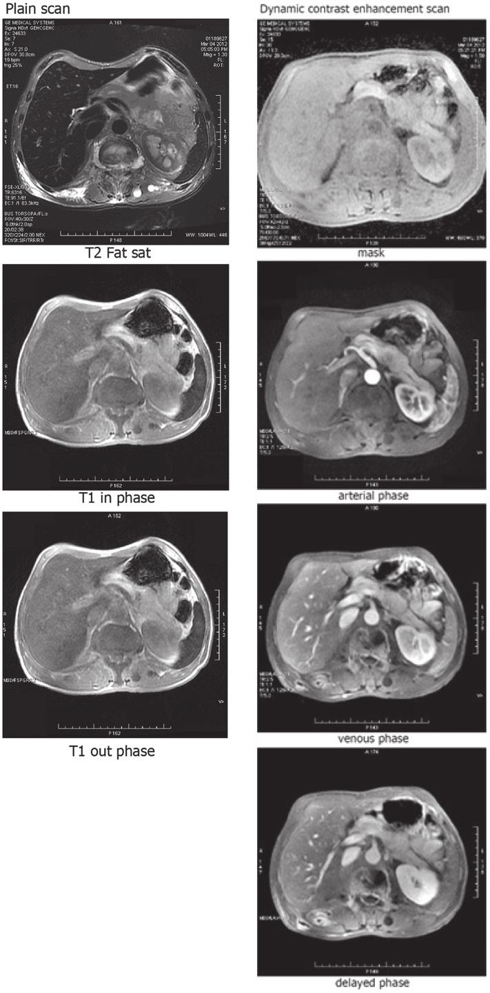 QIAO et al: MISDIAGNOSIS OF PAPILLARY CYSTADENOCARCINOMA 1073 Figure 5. Abdominal magnetic resonance imaging (MRI) scan showing a 2.1x1.