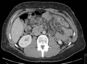 Compression of the SMV Congestion of mesenteric veins secondary to compression of the SMV and hazy, edematous mesentery CT after LGBP a