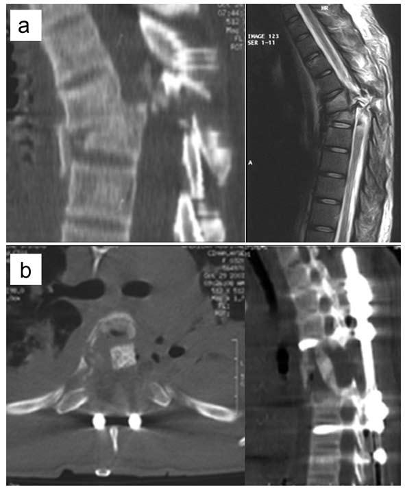 74 Endoscopic Thorocal Precedures (VATS) traffic accident paraplegia traumatic fracture-dislocation Case 4: (Figure