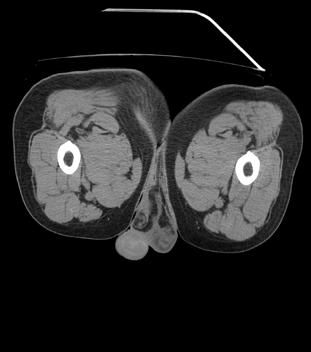 Fig 2a Axial CT scan showing effacement of the left vas deferens and inflammatory fat
