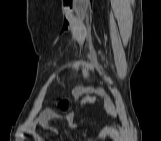 Fig 2b Coronal Reformatted CT scan showing no herniation of bowel loops.