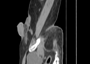 Fig 2c Sagittal Reformatted CT scan showing inflamed left vas deferens and spermatic cord with no bowel herniation.