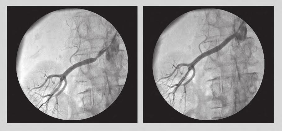 Selecting patients likely to benefit from renal artery stenting Review vessel, which can translate into higher rates of in-stent restenosis.