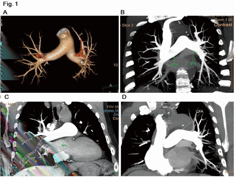 Ma/Zhang/Zhang/Yu the pulmonary trunk and CT scan was triggered when the threshold of 60 HU was reached. The CT images were reconstructed with idose3, with slice thickness of 1.