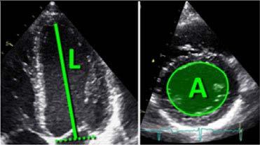 Left ventricle Size Volumes: Area-length Partial correction