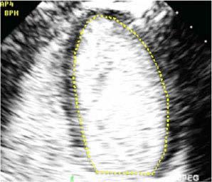 Left ventricle Size Volumes: Endocardial enhancement Useful for