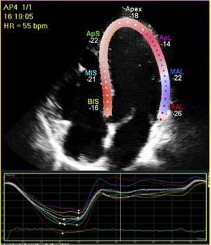 Left ventricle: Global systolic function Global longitudinal strain Angle and vendor independent with