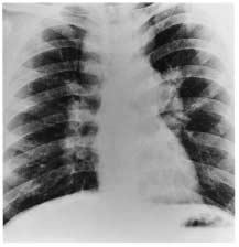 a b c Figure 5 (a) In stage I sarcoidosis, the chest radiograph reveals bilateral hilar and right paratracheal adenopathy with normal lung parenchyma.