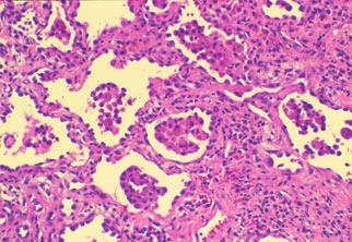 Lung biopsy Transbronchial lung biopsy is a sensitive tool for diagnosing sarcoidosis and lymphangitic cancer and may reveal pathologic features suggestive of IPF (i.e., fibrosis and widened alveolar septa with scant inflammatory cell infiltrate).