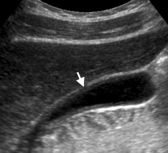 , Longitudinal sonogram of gallbladder, obtained after patient fasted for 12 hours, shows wall