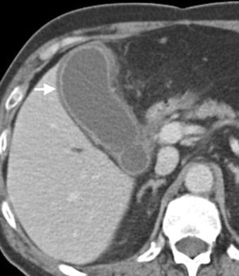 3 59-year-old woman with diffuse gallbladder wall thickening from acute cholecystitis.