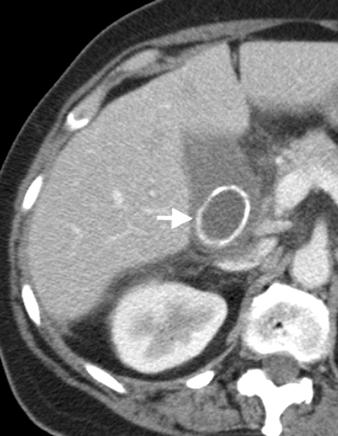 and, Contrast-enhanced CT scans show distended gallbladder (arrowheads, ) with