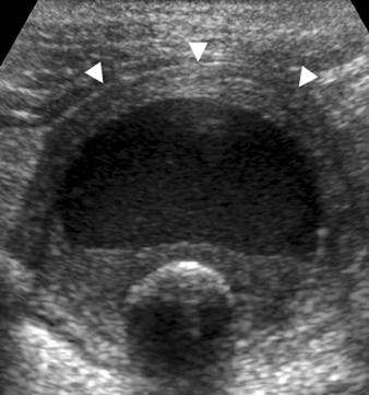 Impacted, obstructing stone (arrow, ) is seen in neck of gallbladder. Fig.