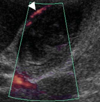 surrounding gallbladder (arrow). Fig.