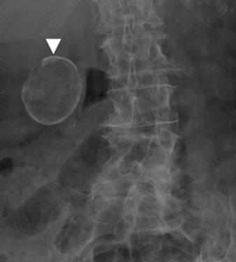 , Transverse sonogram of gallbladder shows marked wall thickening with intramural hypoechoic