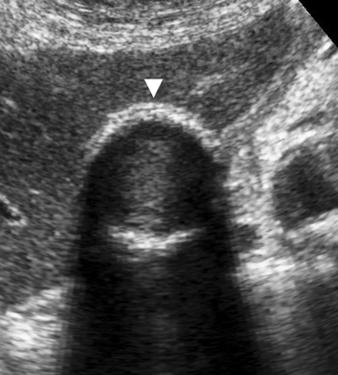 and C, Contrast-enhanced CT scans show deformed and thickened gallbladder wall (arrow, )