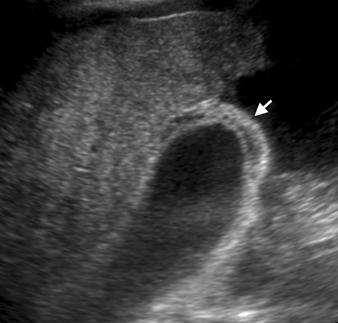 Longitudinal sonogram of gallbladder shows mural thickening with calcifications and stones, with characteristic comet-tail reverberation artifact