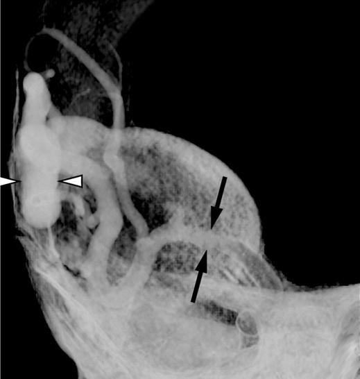 fistula., nteroposterior conventional angiogram shows dilated transverse sinus (arrows).