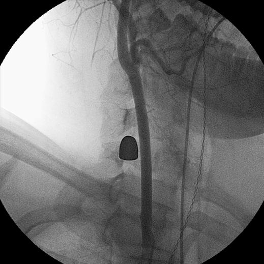 Note artifactual defect suggesting spasm or stenosis of common carotid artery adjacent