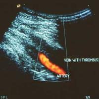 helpful diagnostically An imaging study is done DVT Case 1 DVT Imaging Available imaging and