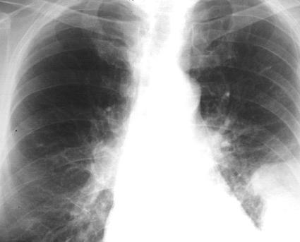 periphery due to infarcted lung