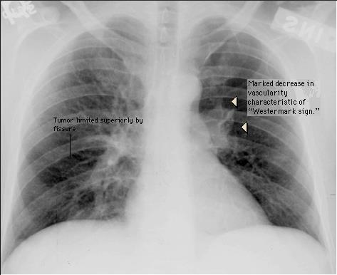 PE Case 2 Findings in the ER Alert white female, mildly anxious T 101, HR 105, RR 18 R LE edema and redness Lungs clear to auscultation ABG mild respiratory alkalosis; aa gradient = 17 CXR showing