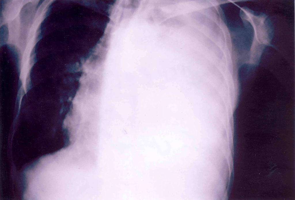 70 Myelomatous Pleural Effusion Figure 1. Chest-x-ray of patient.