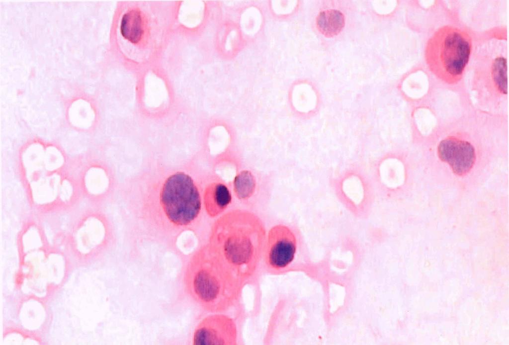 fluid plasmocytoma (Figures 2 and 3). Figure 2. Cytologic examination of the pleural fluid.