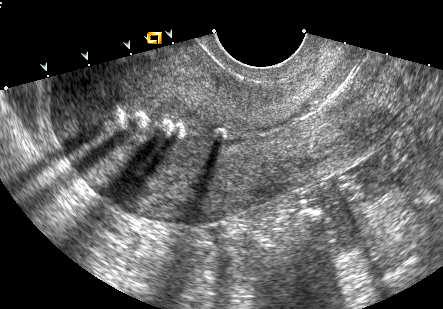 they can be used to help characterize cystic masses and, more importantly, should not be misinterpreted as echoes generated from inside the cyst.