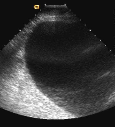 This is most commonly demonstrated in obstetric scanning when acoustic shadows are identified at the margins of a transverse section of the fetal head.