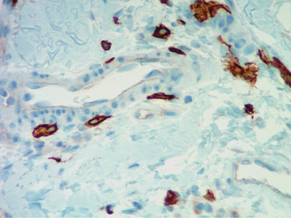 They had a blue rounded nucleus, and their granules were metachromatically stained reddish purple with toluidine blue and brown with CD-117 (C-kit) stain (Figures 3 and 4).