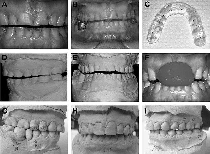 92 Garcia AR et al. Fig. 1 A: poor esthetics due to wear of anterior and posterior teeth. B: bite plate placed in mouth. C: occlusal contact points after achievement of mandibular balance.