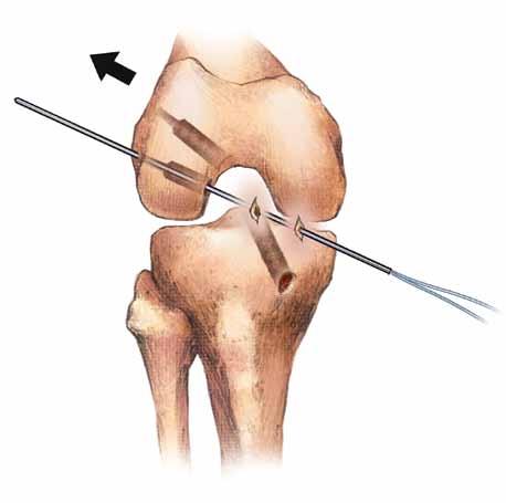 Hyperflex the knee and pass the guidepin through the PL femoral tunnel and pull proximally on the guide wire to pull the relay suture through the