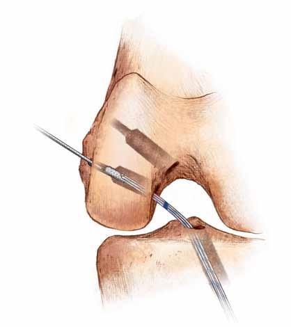 The zip suture should be on the anterior side of the soft-tissue graft prior to graft placement within the femoral tunnel.