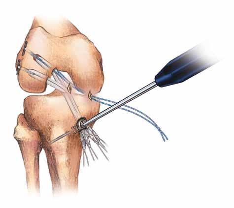 Surgical Technique (continued) 5mm Figure 22 Figure 21 Complete ACL Double Bundle Graft Fixation Tension both the AM and PL soft tissue grafts in full extension and fixate with the